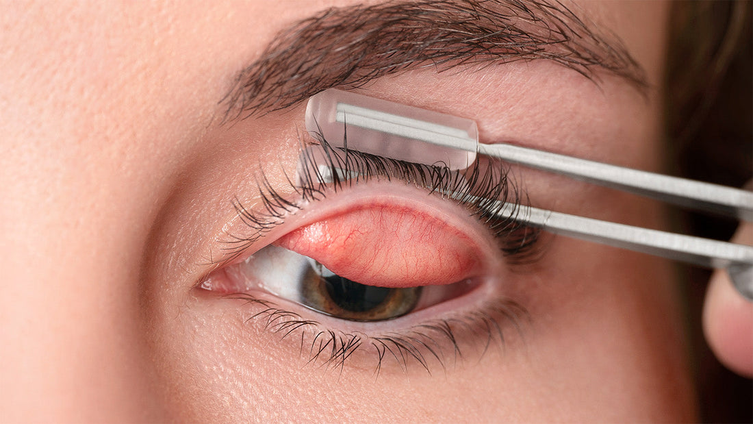 A Safer, More Hygienic Approach to Eyelid Eversion and Foreign Body Removal